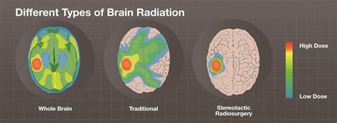 Radiation Therapy Diagram