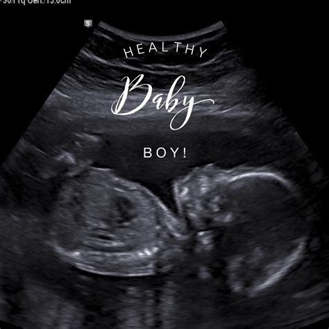 20 Week 5 Month Ultrasound Pictures Of Baby Boy Ldwtanka