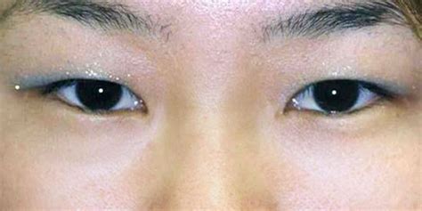 Dr Archie Lamb Asian Double Eyelid Surgery