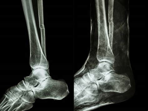 Broken Ankle X Ray Photos Pictures Stock Photos Pictures And Royalty