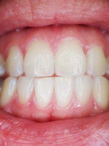 In response to this, white blood cells destroy the infection, and when these white blood cells die they form an abscess. Gum Boil: Causes, Symptoms and Treatment | 25 Doctors
