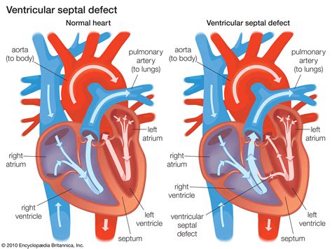 Cardiovascular disease - Abnormalities of individual heart chambers | Britannica