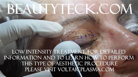 Upper Eyelid Tightening Low Intensity Treatment Example Using Voltaic