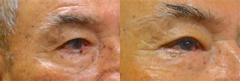 Eyelid Skin Cancer Mohs Reconstruction Before And After Photos