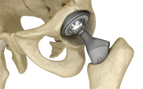 Toxic Fears For More Than 50000 Uk Residents With Metal On Metal Hip