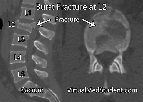 Thoracolumbar Burst Fractures Orthotics And