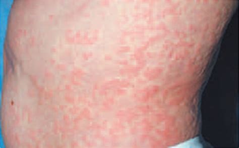 Typical Maculopapular Rash On The Flank Of A Patient With Caps Printed