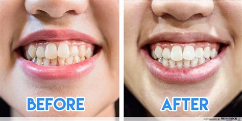 All In Depth Things To Consider About Tooth Whitening Treatment Method