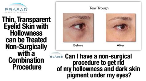 How To Treat Dark Pigmentation Around Eyes