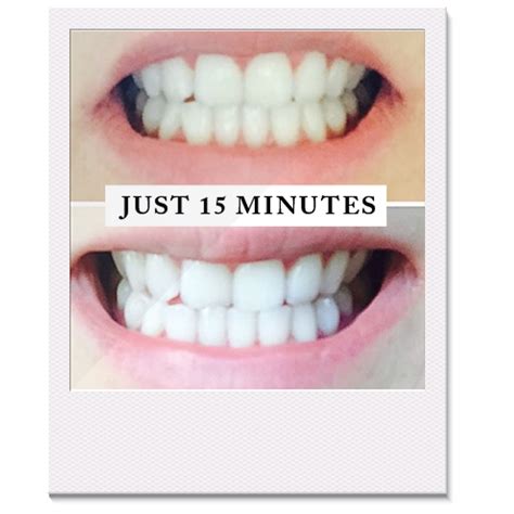 Pearly Whites Professional Teeth Whitening Kit Make Your Teeth White