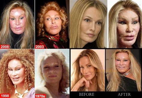 Cat Face Lady Jocelyn Wildenstein Before And After Plastic Surgery