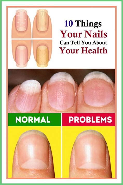 10 Things Your Nails Can Tell You About Your Health Toenails Care
