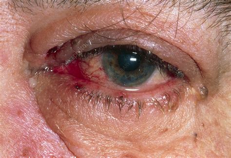 Herpes zoster ophthalmicus occurs when a latent varicella zoster virus in the trigeminal ganglia involving the ophthalmic division of the nerve is reactivated. Eye affected by herpes zoster (shingles) - Stock Image - M260/0173 - Science Photo Library