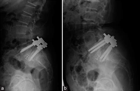 Early Postoperative Sacral Fracture After Short Segment Posterior