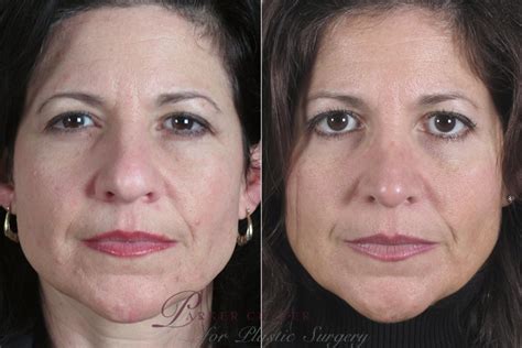 Rhinoplasty Before And After Pictures Case 150 Paramus Nj Parker