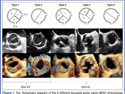 Figure 1 From Assessment Of Bicuspid Aortic Valve Phenotypes And