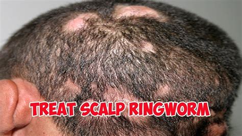 Scalp Ringworm The Head Treatment368 2310 Youtube