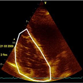 Ultrasound Imaging Of The Heart H Post Scuba Dive Venous Gas Emboli Download Scientific