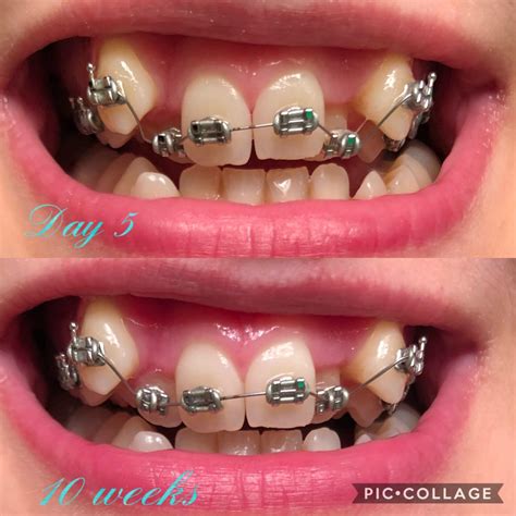 There are plenty of ways to get it out, and you'll develop your own system the longer you wear your braces. 10 weeks. Visible progress! : braces