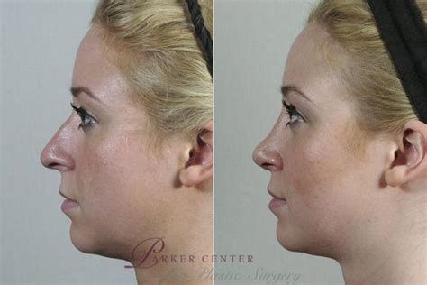 Rhinoplasty Before And After Pictures Case 199 Paramus Nj Parker