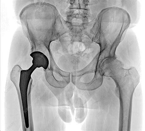 Total Hip Replacement X Ray Stock Image C040 3277 Science Photo