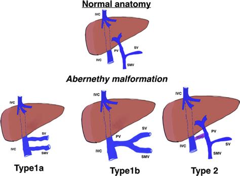 Abernethy Malformation Type 2 Varied Presentation Management And
