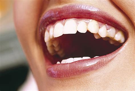 Causes Of Brown Stains On Teeth