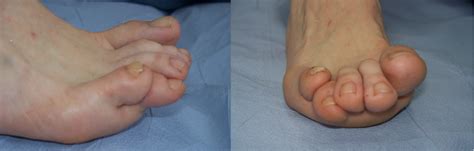 Toe Digital Deformities Consultant Podiatric Surgeon Jonathan Larholt