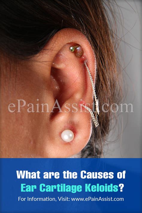 Causes Of Ear Cartilage Keloid And Ways To Get Rid Of It