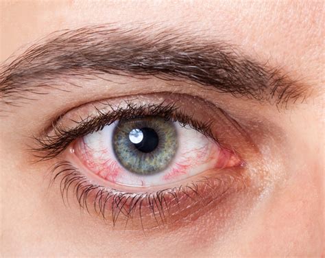 What Causes Red Dry Eyes Rochester Hills Eye Exams At Oakland Optometry