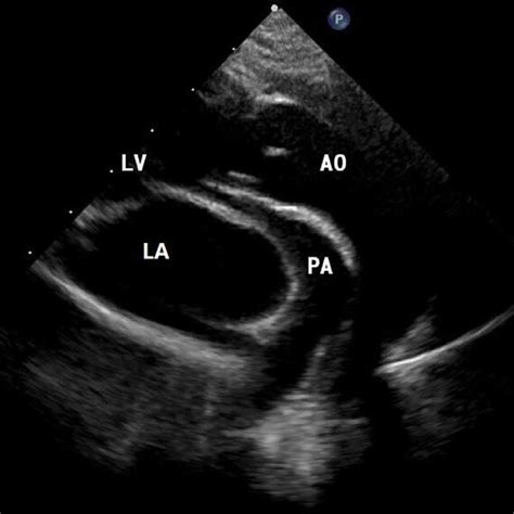 Transthoracic Echocardiography Tte Shows That The Both Great Artery Download Scientific