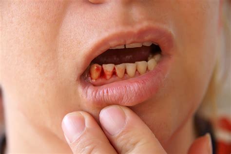 Bleeding Gums Causes Dos And Donts And Treatment Fitness And
