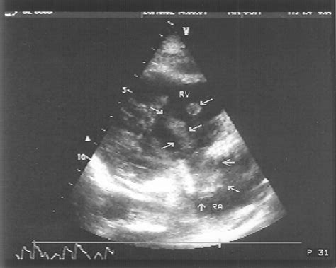 Transgastric Right Ventricular Inflow View Note Arrows Indicating