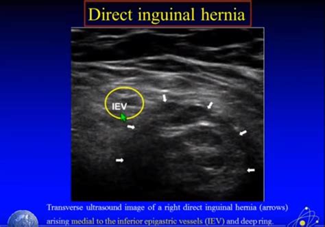 An indirect hernia usually first occurs in infancy. fig27