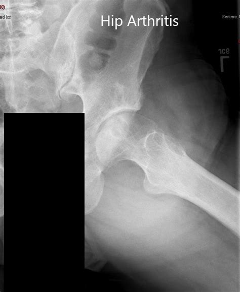 Total Hip Arthroplasty For Developmental Dysplasia Of The Hip 4ba