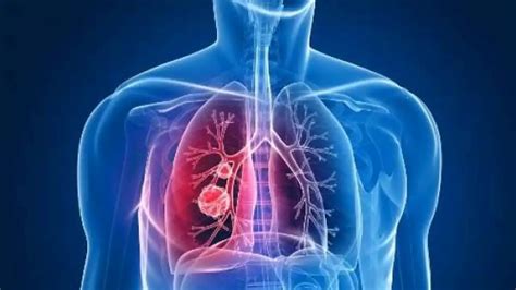 Descubren cómo se adhieren a los pulmones las bacterias que causan el