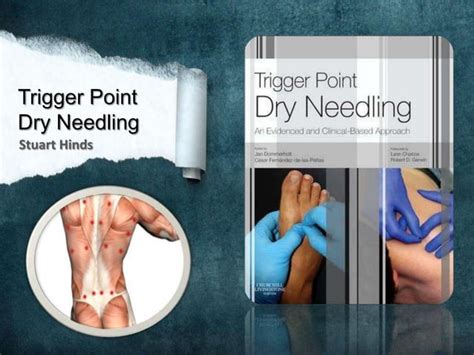 Trigger Point Dry Needling Ppt