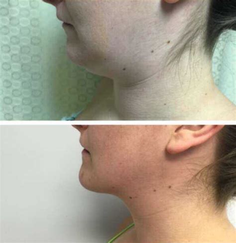 Neck Sculpting And Skin Tightening Gallery Ci Plastic Surgery