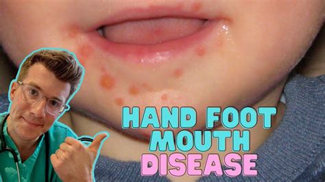 How To Recognise And Treat Hand Foot And Mouth Disease Coxsackievirus