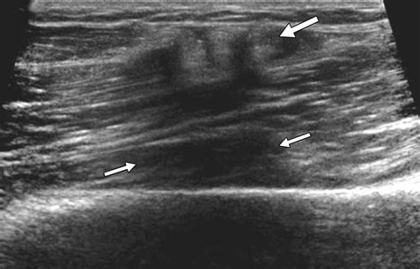 The Role Of Sonography In Differentiating Full Versus Partial Distal