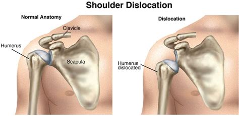 In human anatomy, the shoulder comprises the part of the body where the arm attaches to the torso. What is Shoulder Dislocation and Instability ? - Sports ...