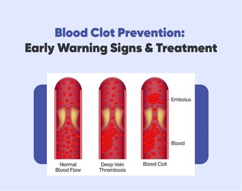 Blood Clot Prevention Early Warning Signs And Treatment