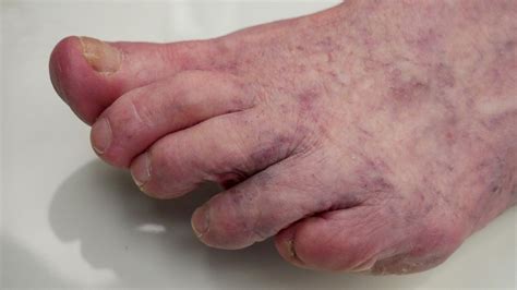 Mottled Skin Livedo Reticularis Causes Signs And Treatment