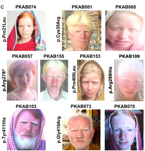 Need Help Do My Essay The Genetic Defect Albinism Thejudgereport827