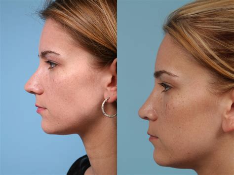 Rhinoplasty By Dr Mustoe Before And After Pictures Case 182 Chicago