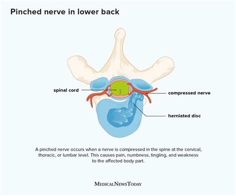 Pinched Nerve In Lower Back How To Tell And More