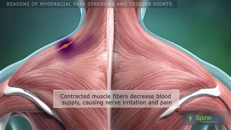 Myofascial Pain Syndrome And Trigger Points Youtube