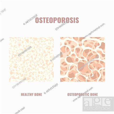Healthy And Osteoporotic Bone Under The Microscope Different Bone