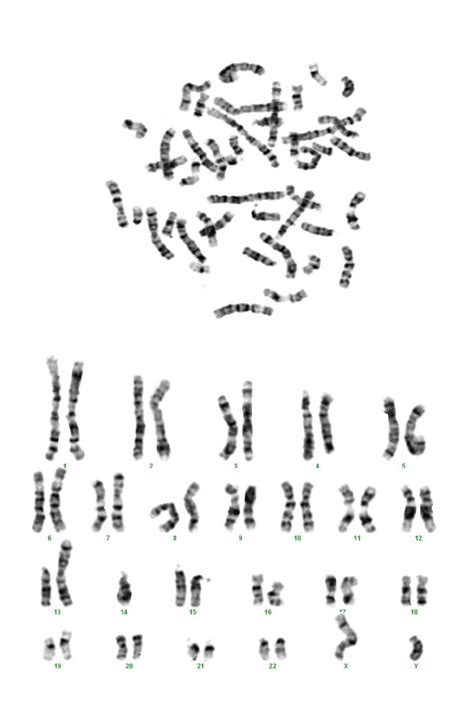 Karyotyping In Patient No 13 Showing 45 XY Der 13 14 Q10 Q10