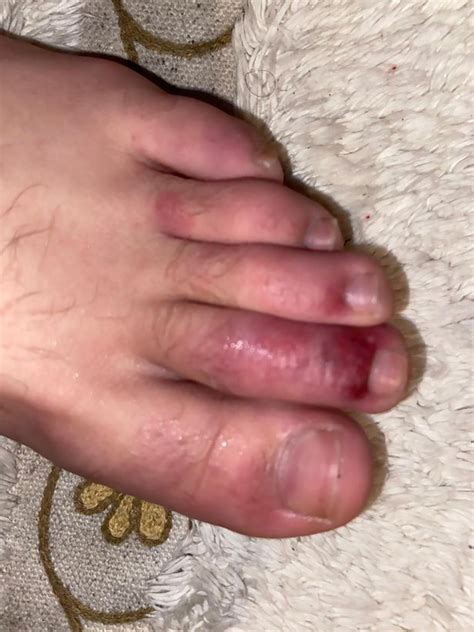 Coronavirus Patient Shows Swollen And Purple Covid Toes That Started